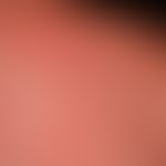 Urticaria chronic spontaneous: multiple, chronically recurrent, red, partly confluent wheals. sev...