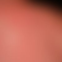 Urticaria chronic spontaneous: multiple, chronically recurrent, red, partly confluent wheals. sev...