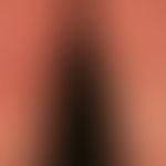 Keratosis lichenoides chronica: generalisiertes eminent chronisches, mäßig juckendes&nbsp; Krankh...