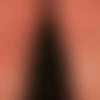 Keratosis lichenoides chronica: generalized eminently chronic, moderately itchy clinical picture ...