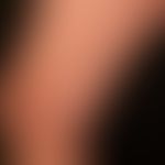 Lichen planus exanthematicus: for several months persistent, itchy, generalized, dense rash with ...