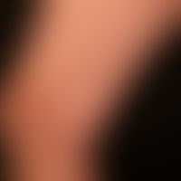 Lichen planus exanthematicus: seit meheren Monaten persistierender, juckender, generalisierter, d...