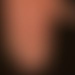 Lichen planus exanthematicus: for several months persistent, itchy, generalized, dense rash with ...
