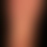 Lichen planus exanthematicus: an itchy, generalized, dense rash with emphasis on the trunk and ex...
