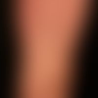 Lichen planus exanthematicus: an itchy, generalized, dense rash with emphasis on the trunk and ex...