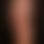Lichen planus exanthematicus: since 2 months persistent, itchy, generalized, dense rash with emph...