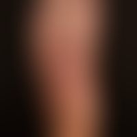Lichen planus exanthematicus: since 2 months persistent, itchy, generalized, dense rash with emph...