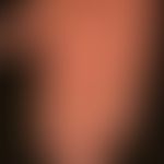 Lichen planus verrucosus: multiple, chronically stationary, moderately sharply defined, itchy, wh...