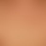 Urticaria pigmentosa: General view: about 0.5-1.0 cm large, disseminated, roundish, brownish-red ...