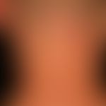 Urticaria pigmentosa: about 0.5-1.0cm large, disseminated, oval or round, brownish-red spots. onl...