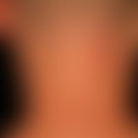 Urticaria pigmentosa: about 0.5-1.0cm large, disseminated, oval or round, brownish-red spots. onl...