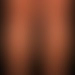 Necrobiosis lipoidica: bilateral, gradually increasing, sharply defined, confluent, reddish-brown...