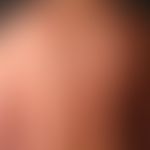 Acne comedonica.  general view: Recurrent multiple, disseminated standing retention cysts of 0.3-...