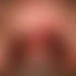 Pemphigus vulgaris: chronisch persistierende, flächenhafte, schmerzhafte Erosionen bei vorbekannt...