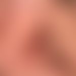 Pemphigus vulgaris: chronisch persistierende, flächenhafte, schmerzhafte Erosionen bei vorbekannt...