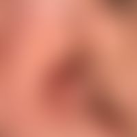 Pemphigus vulgaris: chronisch persistierende, flächenhafte, schmerzhafte Erosionen bei vorbekannt...