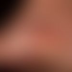 Pemphigus vulgaris: chronisch persistierende, flächenhafte, schmerzhafte Erosionen bei vorbekannt...