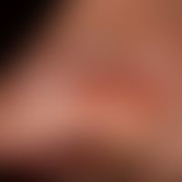 Pemphigus vulgaris: chronisch persistierende, flächenhafte, schmerzhafte Erosionen bei vorbekannt...