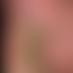 Papillomatosis cutis lymphostatica: massiver Befund mit papillomatösen Wucherungen im Bereich der...