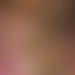 Papillomatosis cutis lymphostatica: Massiver Befund mit papillomatösen Wucherungen an Fußrücken u...