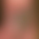 Papillomatosis cutis lymphostatica: massive findings with papillomatous growths on the back of th...