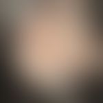 Pseudo-pelade: irregularlylimited, hairless area. follicular structure in the hairless area is co...