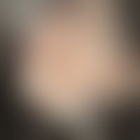 Pseudo-pelade: irregularlylimited, hairless area. follicular structure in the hairless area is co...