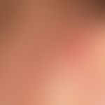 Pyoderma: recurrent pyoderma with weeping and encrusted erosions in a patient with atopic eczema ...