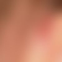 Pyoderma: recurrent pyoderma with weeping and encrusted erosions in a patient with atopic eczema ...