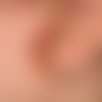 Atopische Dermatitis&nbsp;(impetiginisierte Ohrläppchenrhagade): bei der 10-jährigen Patientin re...