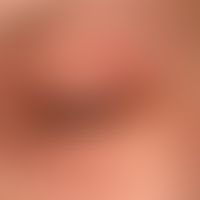 Dermatitis, atopische: chronisches, unangenhem juckende Dermatitis beider Augenlider. Bekannte at...