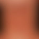 Eczema user, atopic. brownish, dry, scaly and itchy plaques on lichenified ground. 16-year-old fe...