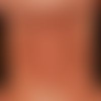 Eczema user, atopic. brownish, dry, scaly and itchy plaques on lichenified ground. 16-year-old fe...