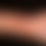 Dermatitis atopic: Skin lesions in a 14-year-old girl with generalized atopic dermatitis. Accentu...
