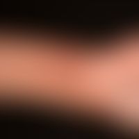 Dermatitis atopic: Skin lesions in a 14-year-old girl with generalized atopic dermatitis. Accentu...