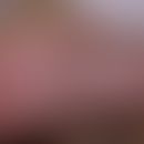 Kongenitales fibrolipomatöses Hamartom des Fersenbeins:&nbsp; angeborene weiche Vorwölbung der Ha...