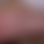 Congenital fibrolipomatous hamartoma of the calcaneus: congenital soft bulge of the skin, Figure ...