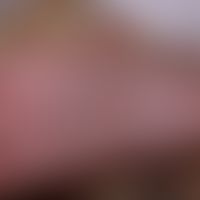 Congenital fibrolipomatous hamartoma of the calcaneus: congenital soft bulge of the skin, Figure ...