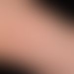 Psoriasis guttata: de novo aufgetretene, 0,1-2,0 cm große, rötliche, raue Papeln und&nbsp; Plaque...