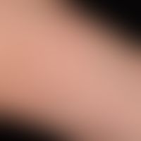Psoriasis guttata: de novo aufgetretene, 0,1-2,0 cm große, rötliche, raue Papeln und&nbsp; Plaque...