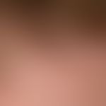 Psoriasis capitis: chronic, months-old, moderately sharply defined, symptom-free, whitish (scaly ...