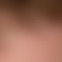 Psoriasis capitis: chronic, months-old, moderately sharply defined, symptom-free, whitish (scaly ...