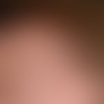 Psoriasis capitis: chronically inpatient red and white plaques, localised on the forehead and cap...