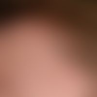 Psoriasis capitis: chronically inpatient red and white plaques, localised on the forehead and cap...
