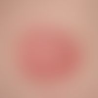 Psoriasis: nicht vorbehandelte psoriatische Plaque, scharf begrenzt, vergröbertes Oberflächenreli...