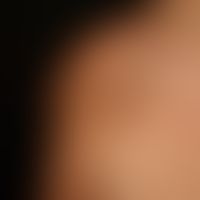 Becker-Naevus: During puberty and postpubertal increasing hairiness of a nevus previously only vi...