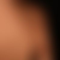 Becker-Naevus: During puberty and postpubertal increasing hairiness of a nevus previously only vi...