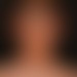 Graft-versus-Host-Disease: chronic. 1.5 years after stem cell transplantation, large-area, sclero...