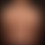 Generalized GVHD:chronic, generalized, poikilodermatic skin changes, with circumscribed calluses,...