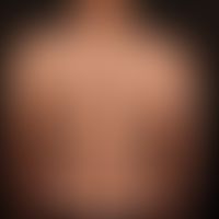 Generalized GVHD:chronic, generalized, poikilodermatic skin changes, with circumscribed calluses,...